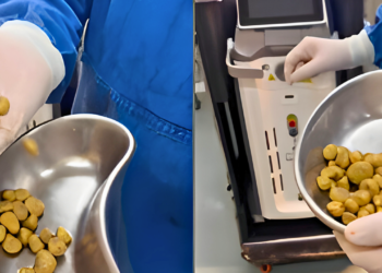 Médico retira 35 pedras dos rins de paciente viciado em refrigerante