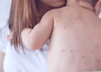 Surto de sarampo nos EUA já causou duas mortes