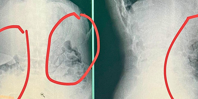 Presos tentam voltar da ‘saidinha’ com drogas no estômago em Valadares