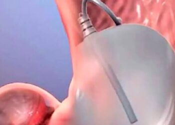 Primeiro procedimento de balão gástrico gratuito será realizado nessa quarta ( 24/07 ) em Valadares