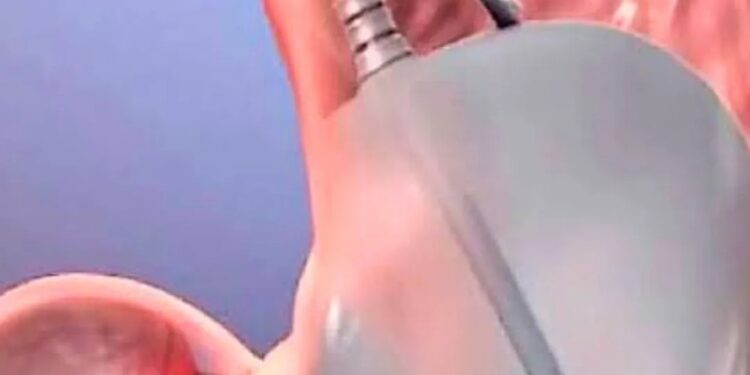 Primeiro procedimento de balão gástrico gratuito será realizado nessa quarta ( 24/07 ) em Valadares